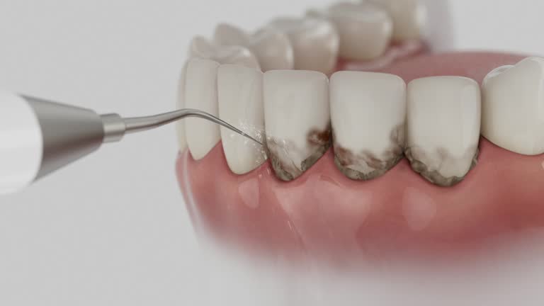 Reliable Dental Implants contractor in Belleview, FL by Smile Center Dentistry